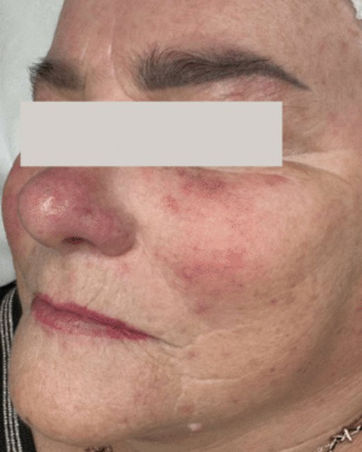Avant — exemple Alpha Lift · Rougeurs · quatre soins
