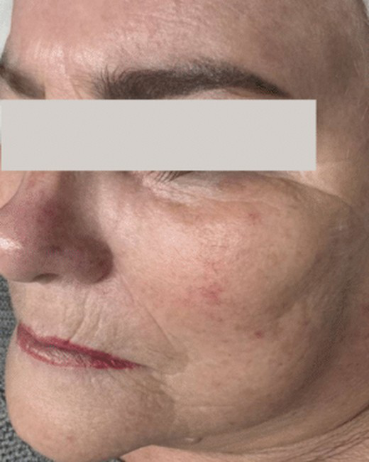 Après — exemple Alpha Lift · Rougeurs · quatre soins