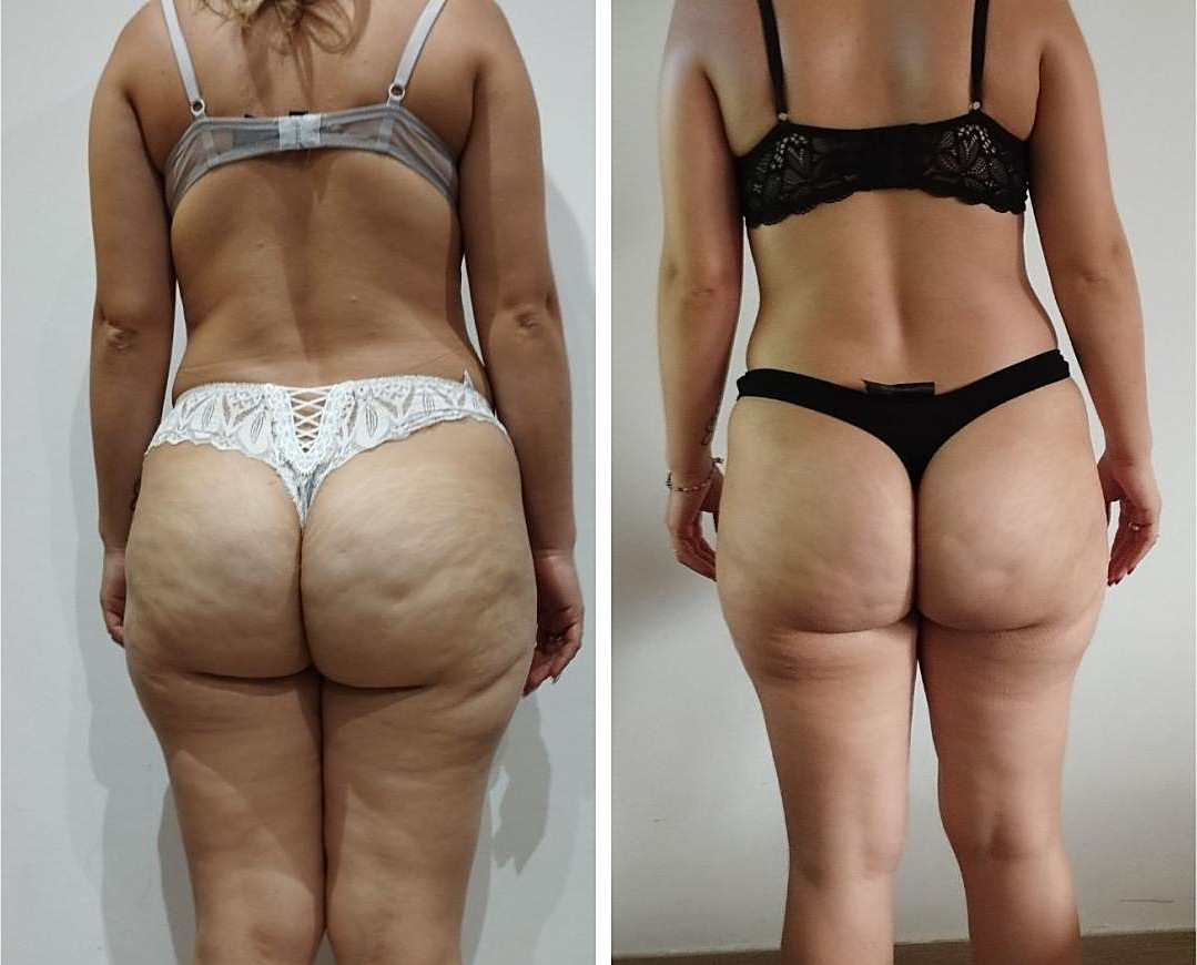 Comparaison avant et après présentée dans la plaquette pour la Méthode Magda
