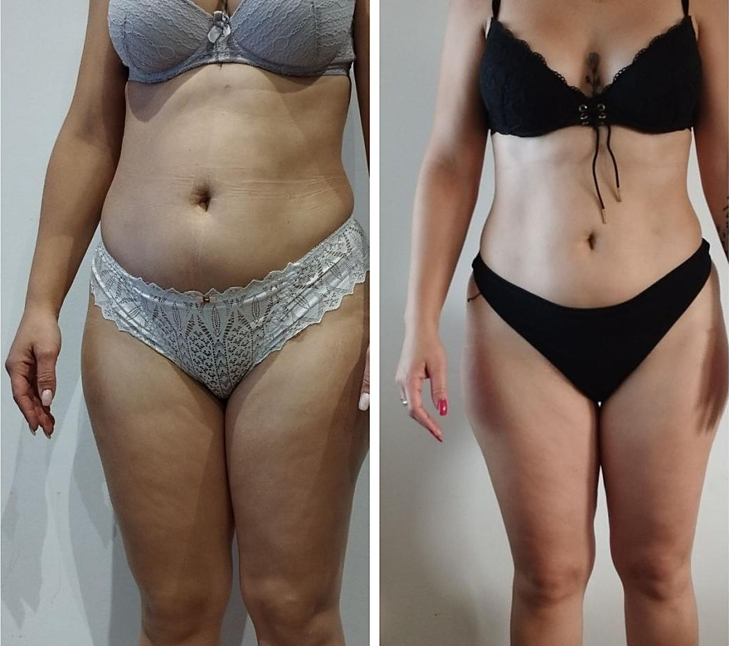 Comparaison avant et après présentée dans la plaquette pour la Méthode Magda